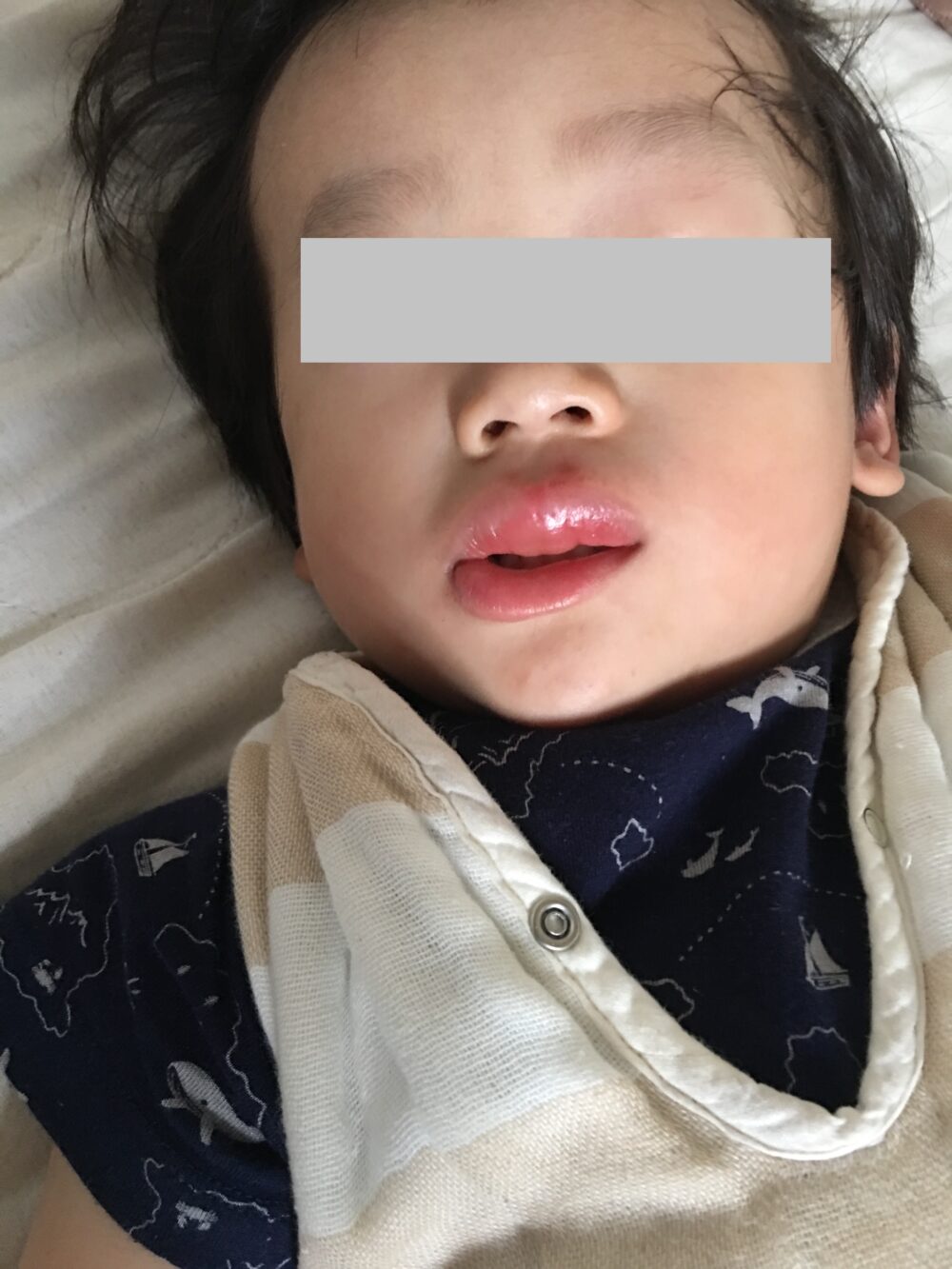 アレルギーで唇と目が腫れる20180728