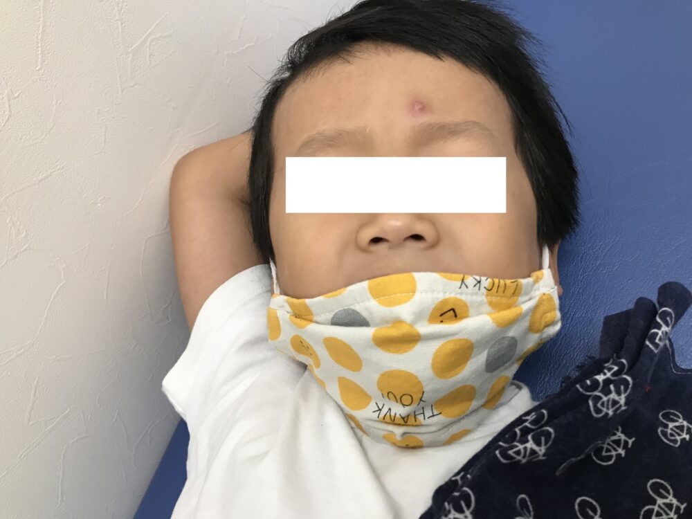 虫刺されから蜂窩織炎になることはありますか？